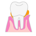 歯周病の進み方２