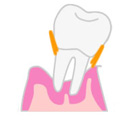 歯周病の進み方３